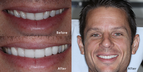 Before and after photo of Phoenix patient with six porcelain veneers on top and six dental veneers on bottom.
