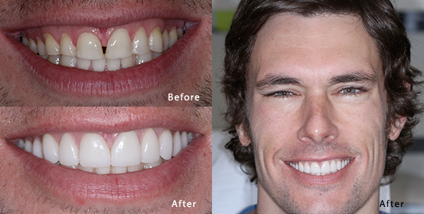 Patient from Phoenix before and after receiving prepless dental veneers.