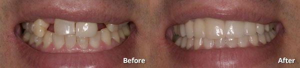 Before and after photos of bridged and veneers patient in Phoenix