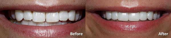Before and after photos of prepless porcelain veneers with Dr. Joe Harris