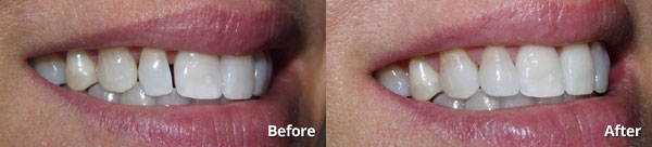 Before and after photos of a single prepless veneer at Harris Dental