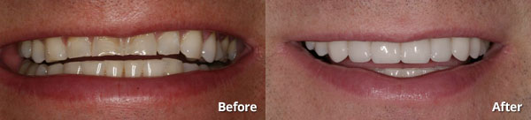 Before and after photo of porcelain veneers patient at Harris Dental
