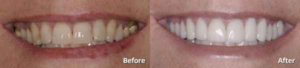 Before and after photos of patient who received 12 porcelain restorations in Phoenix