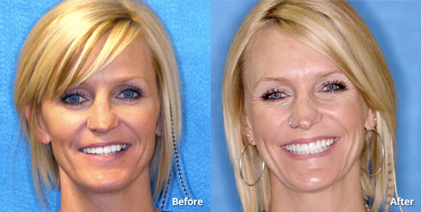 Before and after receiving porcelain teeth veneers in Phoenix.