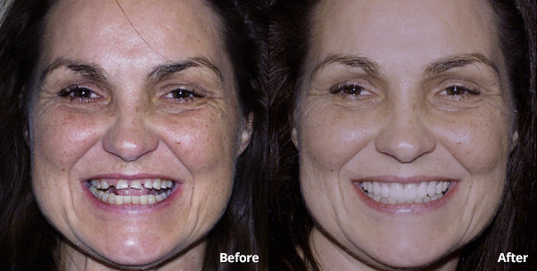Before and after photos of a porcelain restorations patient at Harris Dental