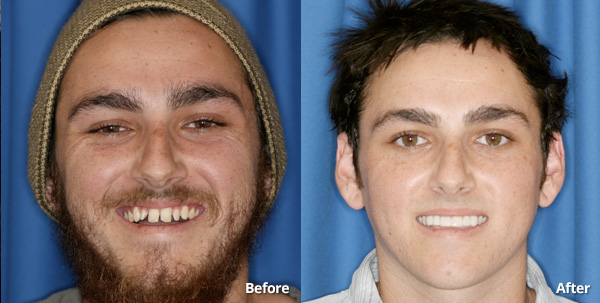 Man from Phoenix before and after undergoing restorative dentistry procedures.