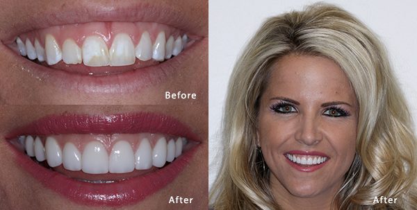 Before and after receiving ten porcelain teeth veneers in Phoenix.
