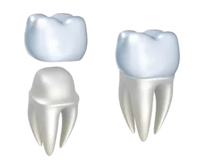 Dental crowns can help fix a broken or cracked tooth.